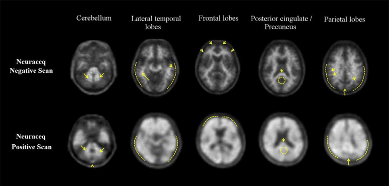 Axial view of negative (top row) and positive (bottom row) Neuraceq PET scans - Illustration