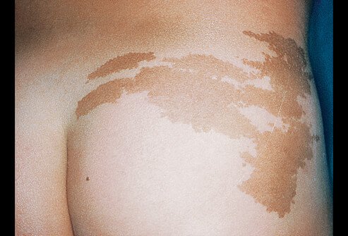 Picture of Neurofibromatosis (Café au lait)