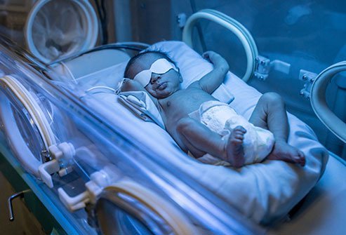 Jaundice is yellowish discoloration of the skin and eyes