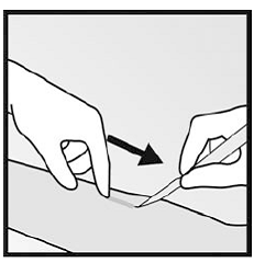 Push down the proximal end of the implant - Illustration