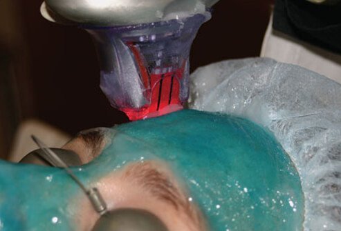 The idea of nonablative lasers like Fraxel is to protect the outer layers of the skin (the epidermis) while damaging only the deeper dermis.