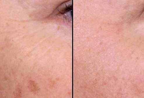 One of the advantages of nonablative laser therapy is that it does not require significant time away from work or daily activities.