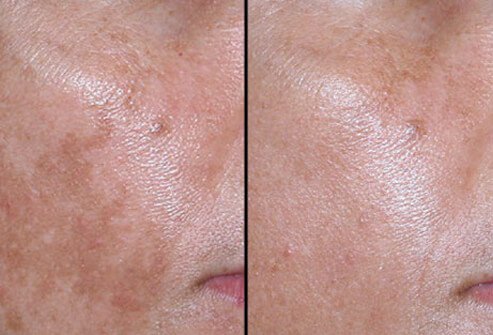 The doctor will determine the best treatment depending on the patient's skin color, the extent of discoloration, and their experience.