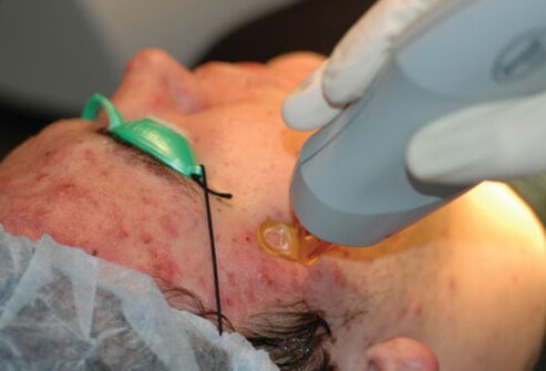 Diode laser is a technique that can achieve improvements by destroying oil-producing glands for those with severe acne.