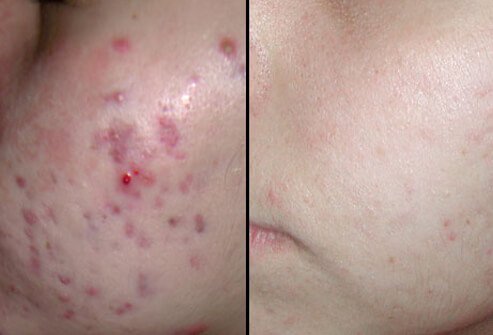 Diode laser therapy for acne may require several treatments.