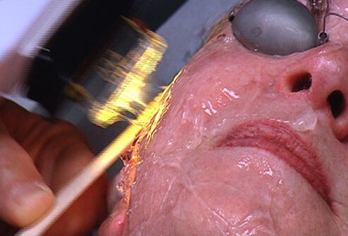 Intense pulsed light (IPL) technology exposes human tissues to broad spectrum (non-laser) light sources that produce enough heat to destroy colored molecules that can absorb the light.