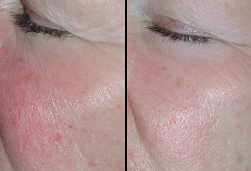 Since IPL relies upon the absorption by hemoglobin and melanin, it can work on skin discolorations that are red or brown.