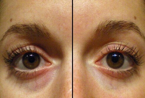 Physicians may use fillers in the hollow area around the eye socket to minimize dark circles and bags under the eyes.