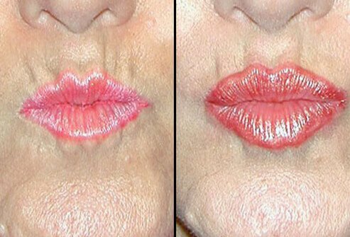 Health-care professionals may use the same fillers that plump wrinkles and minimize dark circles to plump the lips.