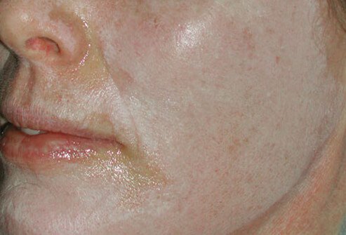 Chemical peels use a variety of substances to damage the skin in order to exfoliate the outer layers.