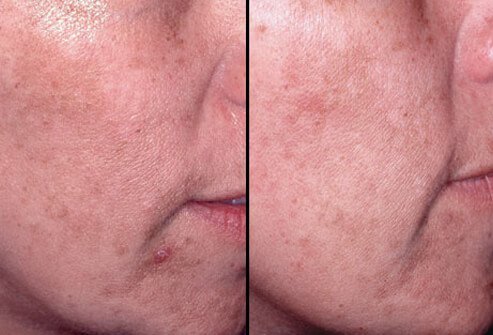Mild peels may be repeated every few weeks for the desired effect.