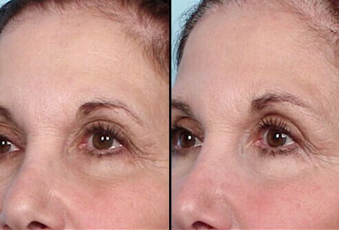 Droopiness of the eyelids is one condition often treated by Thermage.