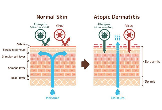 Psoriasis and atopic dermatitis are common, long-term skin diseases.