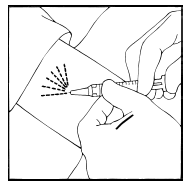 Anesthetize the insertion area - Illustration