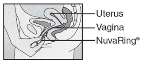 Insert NuvaRing into your vagina - Illustration