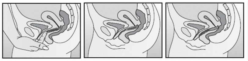 Inserting NuvaRing - Illustration