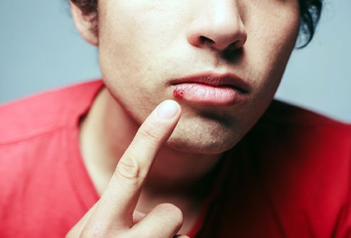 Herpes is a sexually transmitted infection that you can carry without having any symptoms. Herpes can't be cured, but outbreaks can be managed and prevented.