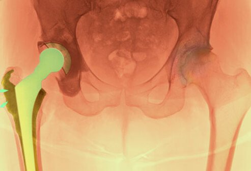 When osteoarthritis symptoms persist despite other therapies, joint replacement surgery is often considered.