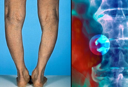 Osteoarthritis does not affect internal organs like rheumatoid arthritis can.