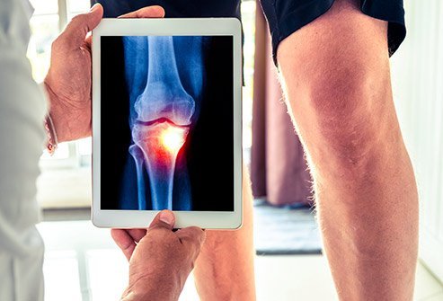 Treatment for Osteoarthritis (OA) varies from person to person, and can include exercise, medication, surgery, and supplements.