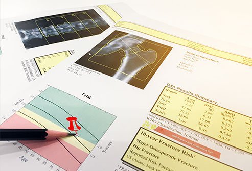 Decreased bone density characterizes osteopenia.