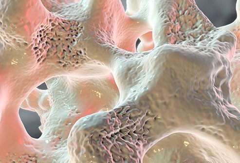 Osteoporosis is a bone disorder. Bone loss happens when the body absorbs more bone than it can create