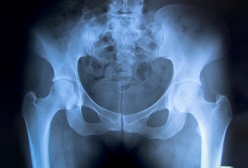 Picture of Hip Fracture