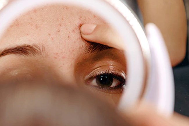Birth control pills help lower levels of male hormones that contribute to acne breakouts.
