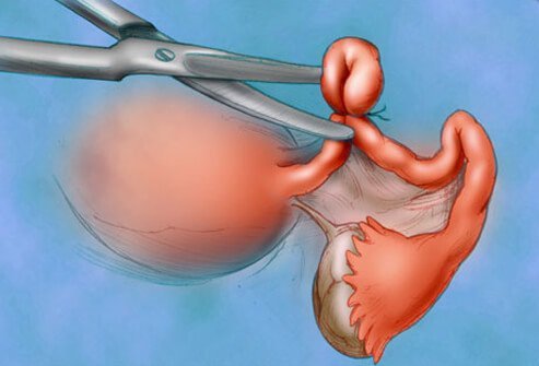 Tubal ligation decreases the risk of ovarian cancer, but it is not done expressly for this purpose.