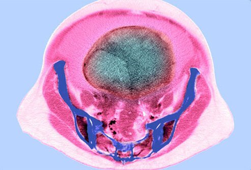 Tests for ovarian cancer diagnosis include imaging studies and biopsy.