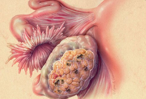 Signs, symptoms of ovarian cancer tend to be apparent in the later stages of the disease.