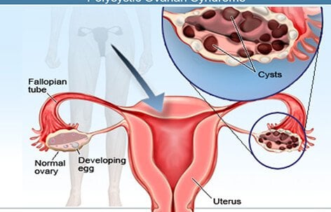 The most common type of ovarian cyst is called a functional cyst.