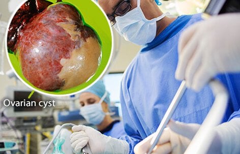 If an ovarian cyst continues to grow, does not resolve on its own, appears suspicious on ultrasound, or is causing symptoms, the doctor may recommend surgical removal.