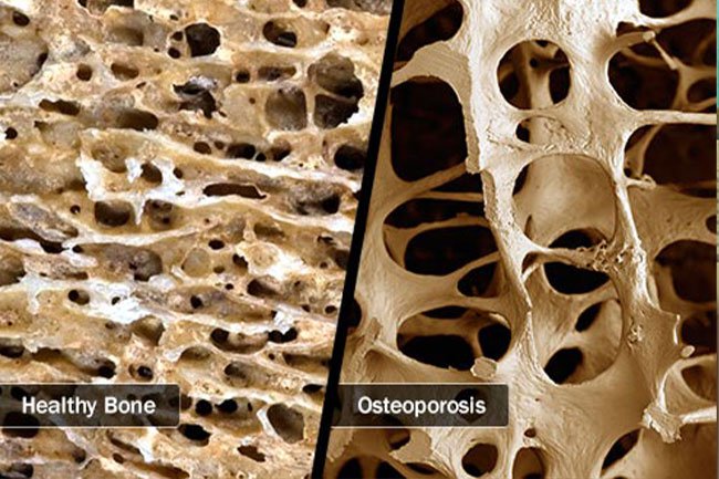 Osteoporosis causes your bones to become weak and could lead to fractures.