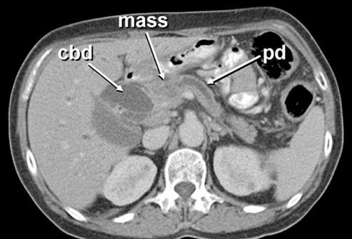 Picture of Pancreatic Cancer