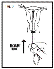 Inserting Tips of T-Arms of Paragard into Insertion Tube While in Sterile Packaging - Illustration