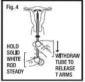 Insertion Tube with Paragard in Uterus - Illustration