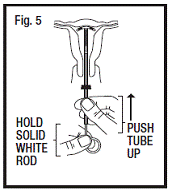 Release T-arms of Paragard in Uterus  - Illustration