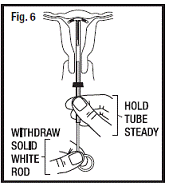 Placement of Paragard in Fundus of Uterus - Illustration