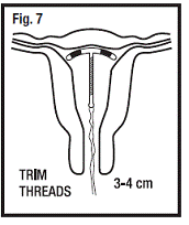 Withdraw Solid White Rod from Uterus - Illustration