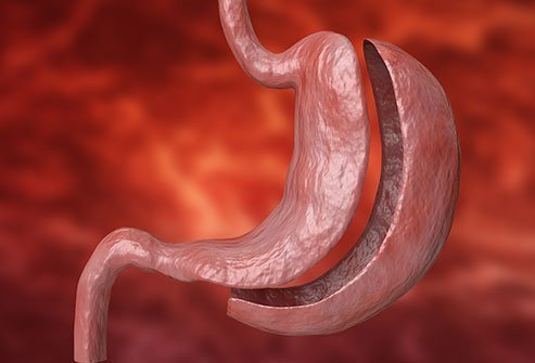 A partial gastrectomy is usually performed with the patient under general anesthesia by a gastrointestinal surgeon. The surgery is performed in an operation theater, and may take up to five hours and require up to two weeks of recovery in the hospital.