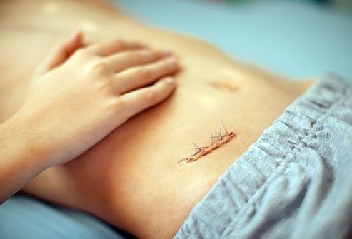 Most children will be able to go home within a day after an appendectomy if the appendix is not ruptured. After appendectomies involving rupture and severe contamination, the child will require IV administration of antibiotics with hospital stay extended from five to seven days.