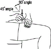 Insert the needle into the pinched skin at a 45- to 90-degree angle with a
quick dart-like motion - Illustration