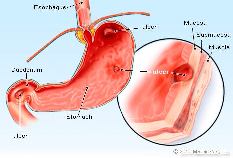 Peptic Ulcer Illustration