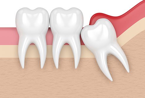 Pericoronitis is a condition marked by the gum growing over wisdom tooth.