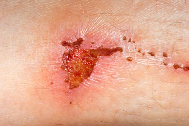 Petroleum jelly is good for your wounds.