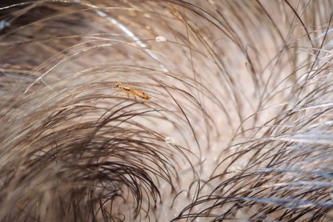 Petroleum jelly is a home remedy for lice.
