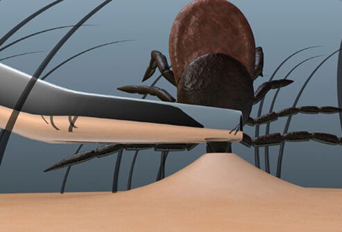 Illustration of tick removal.