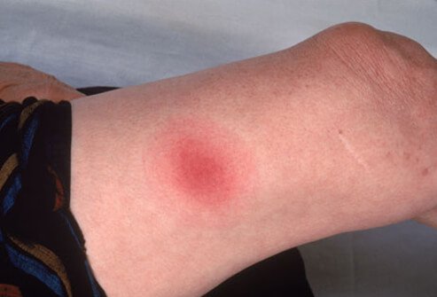 Photo of woman with lyme disease.