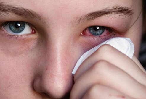 Pink eye is a common name for conjunctivitis, a condition that causes inflammation and redness of the membranes inside the eyes. 